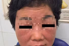 Bôi thuốc gia truyền làm trắng, người phụ nữ bị đỏ da, bong vảy toàn bộ mặt