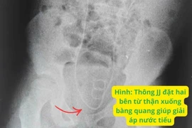 Trẻ 9 tuổi tổn thương thận cấp sau mổ ruột thừa do sỏi niệu quản kẹt