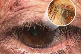 Phát hiện ổ rận mu ký sinh ở mí mắt người phụ nữ
