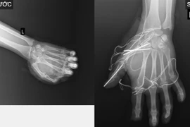 Suýt mất bàn tay vì đốt pháo nổ