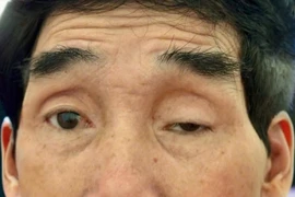 Giải phóng mí mắt sụp cho người đàn ông 65 năm 'nhìn đời qua khe cửa hẹp'