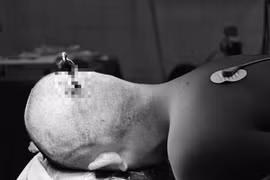 Trẻ 14 tuổi bị dị vật xuyên sọ, cảnh báo tai nạn học đường