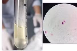 4 ca tử vong do não mô cầu, Bộ Y tế chỉ cách phòng chống