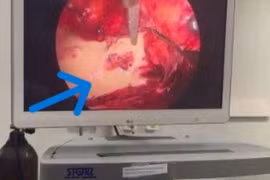 Đau bụng, tiểu đục do sỏi niệu quản 2 cm án ngữ đài bể thận