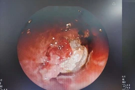 Kịch tính lấy dị vật 'tàng hình' mắc kẹt trong phổi thiếu niên 15 tuổi