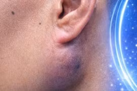 Cẩn thận khối u to nhanh bất thường dưới tai, ăn nhai khó chịu