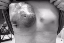 Cá thể hóa cứu bệnh nhân 41 tuổi u vú khổng lồ 2 bên, di căn xương
