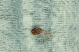 Bé 9 tuổi đau quặn thận do sỏi niệu quản, khuyến cáo khi trẻ đau bụng