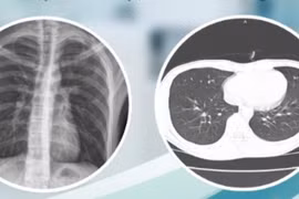 Đau tức ngực khó thở, trẻ 16 tuổi khỏe mạnh tràn khí màng phổi do vỡ kén khí