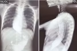 Trẻ sợ ăn kéo dài không ngờ do co thắt tâm vị nguyên phát