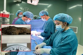 Lấy thành công búi tóc 0,5 kg trong dạ dày bé gái ở Quảng Ngãi