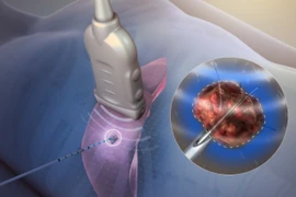 Điều trị ung thư gan bằng đốt sóng cao tần, khi nào được chỉ định?