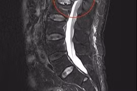 Tổn thương tủy sống do loãng xương gây xẹp đốt sống dễ liệt chi