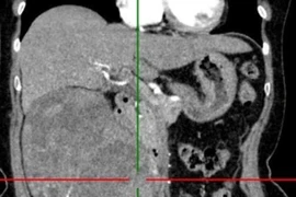 Loại bỏ khối u thận 1,2kg cho người bệnh 72 tuổi đau âm ỉ vùng lưng hông