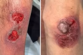 Nhiều người ngộ độc methotrexate nặng khi uống thuốc trị bệnh da liễu