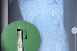 Vỗ lưng đẩy đinh vít 2,5 cm ra ngoài khiến dị vật trôi sâu hơn