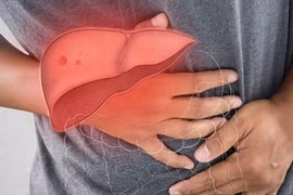 Cách phục hồi nhanh sau nút mạch điều trị ung thư gan