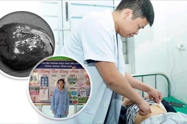 Cắt lách bán phần điều trị u nang lách khổng lồ cho bệnh nhi 14 tuổi