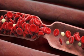 Chuyên gia mách cách làm sạch mạch máu cho cơ thể khỏe mạnh