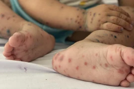 Hà Nội giảm số ca sốt xuất huyết, tăng ca tay chân miệng trong tuần