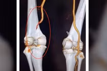 Giữ chân cho bệnh nhân Phú Thọ bị đứt mạch máu khoeo