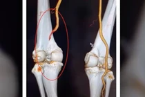 Giữ chân cho bệnh nhân Phú Thọ bị đứt mạch máu khoeo