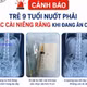 Trẻ 9 tuổi nuốt phải mắc cài niềng răng khi ăn cơm