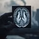 Ô nhiễm không khí làm tăng nguy cơ mắc bệnh Parkinson và các bệnh thần kinh