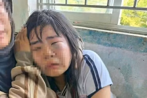 Em D.T.K (học sinh lớp 7A, Trường THCS Bình Thuận) bị bạn đánh sưng húp mặt, mắt bầm tím