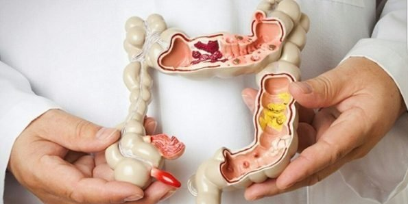 Ăn nhiều quả hồng cũng dễ bị táo bón, thậm chí gây tắc ruột.