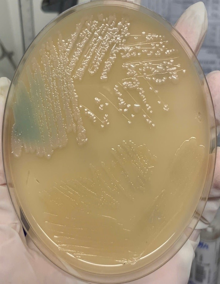 Ổ áp xe cổ tay phải và kết quả cấy máu bệnh nhân Bùi Thị C. - Ảnh: BVCC