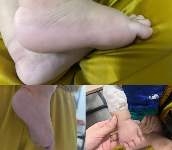 Phù bàn tay, chân trước khi được điều trị - Ảnh: BVCC