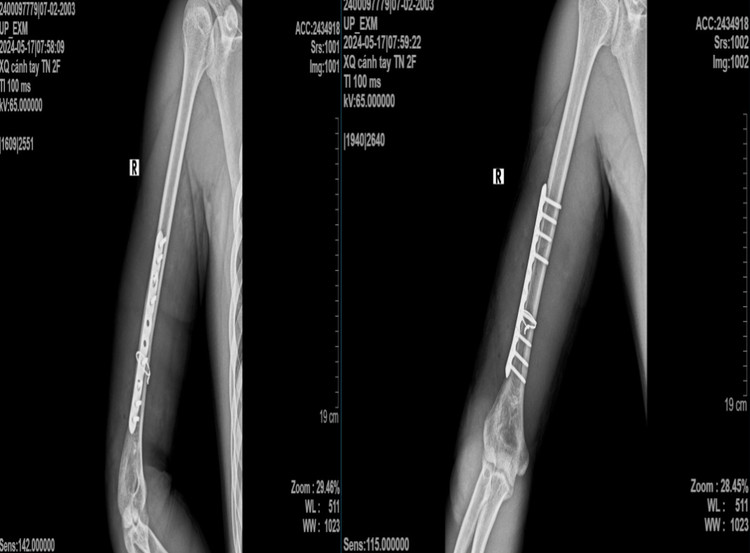 Hình ảnh x-quang sau phẫu thuật của bệnh nhân - Ảnh: BVCC Hình ảnh x-quang sau phẫu thuật của bệnh nhân - Ảnh: BVCC
