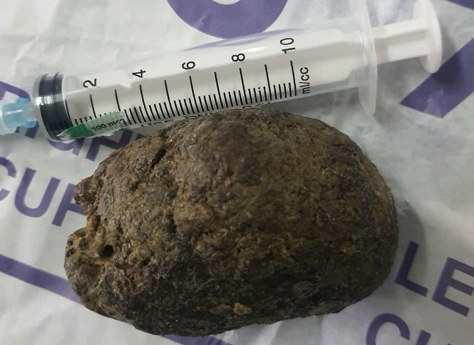 Khối bã thức ăn lớn trong dạ dày của bệnh nhân - Ảnh: BV Đa khoa tỉnh Ninh Bình