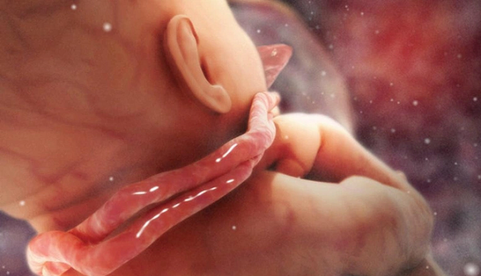 Vòng hoa quấn cổ là tình trạng dây rốn quấn quanh cổ thai nhi một vòng hay nhiều vòng - Ảnh minh hoạ