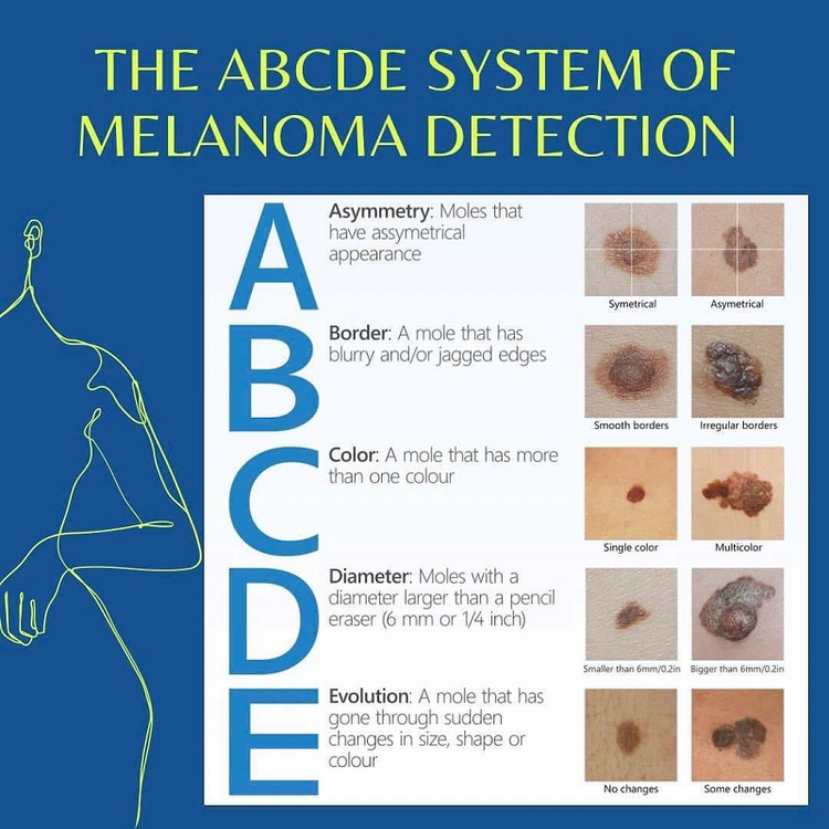 Các dấu hiệu cảnh báo nguy cơ của bệnh ung thư da hắc tố (viết tắt là ABCDE) - Ảnh: BVCC Các dấu hiệu cảnh báo nguy cơ của bệnh ung thư da hắc tố (viết tắt là ABCDE) - Ảnh: BVCC