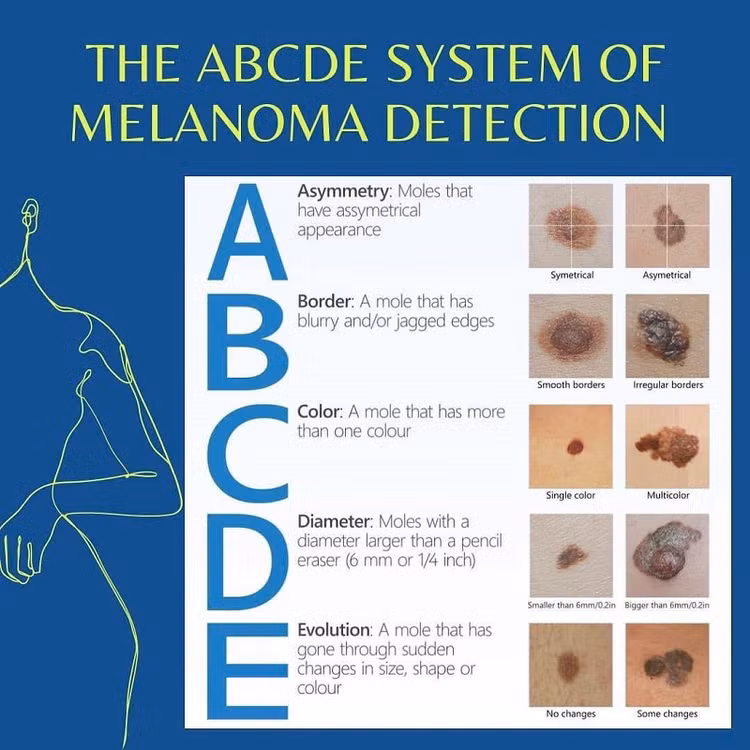 Các dấu hiệu cảnh báo nguy cơ của bệnh ung thư da hắc tố (viết tắt là ABCDE) - Ảnh: BVCC