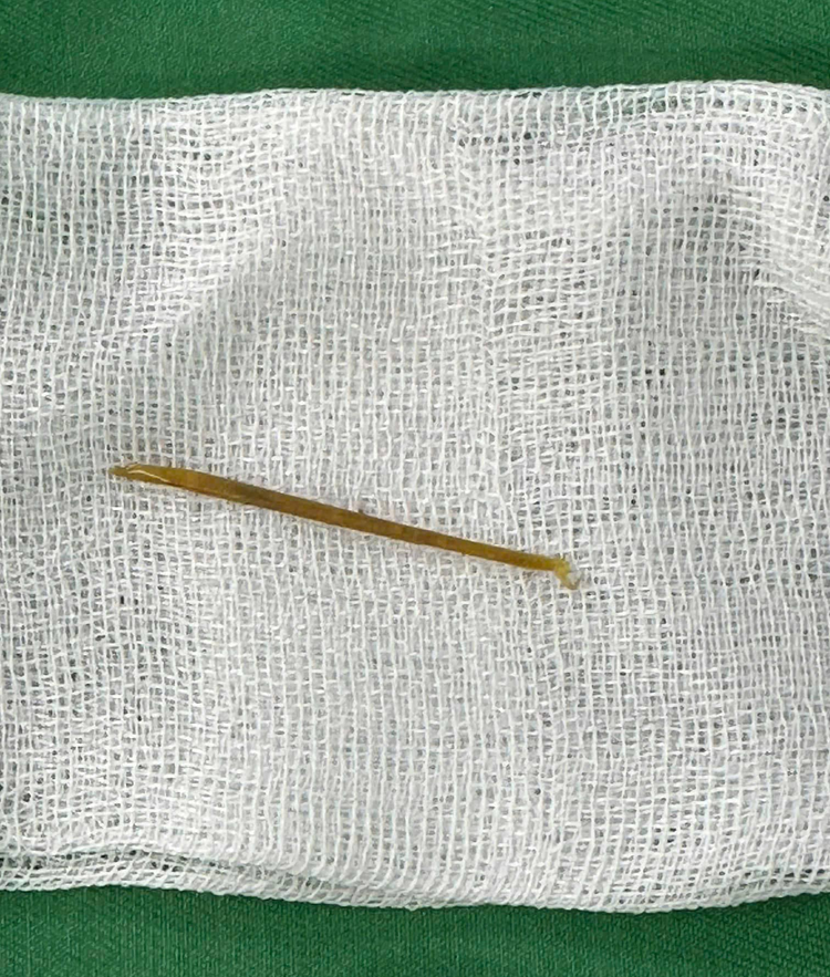 Người phụ nữ thủng ruột non do nuốt phải tăm tre - Ảnh: BVCC