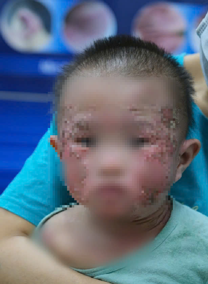 Bé trai bị viêm da cơ địa diễn biến nặng. Ảnh: Tạp chí điện tử Người Đưa Tin Bé trai bị viêm da cơ địa diễn biến nặng. Ảnh: Tạp chí điện tử Người Đưa Tin