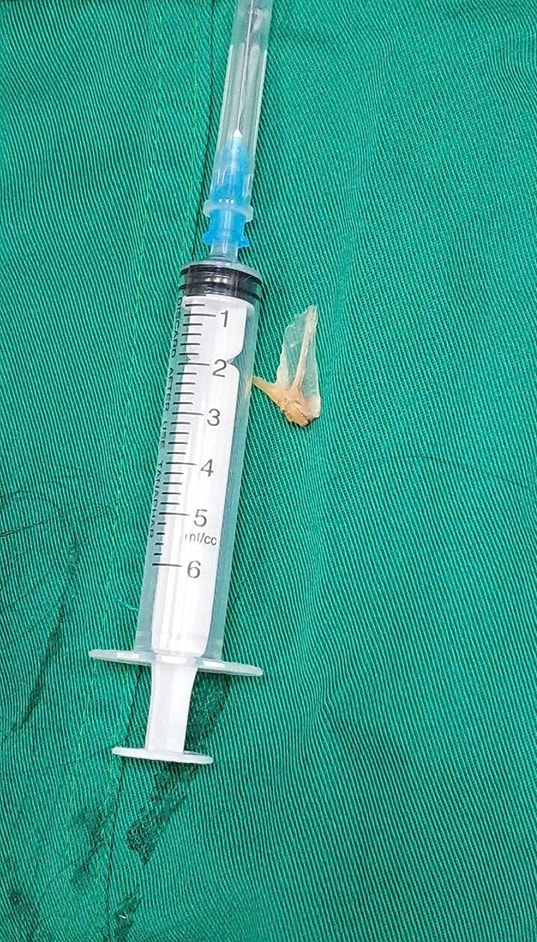 Dị vật bị mắc trong phế quản được đội ngũ y bác sĩ lấy ra. Ảnh: BVCC