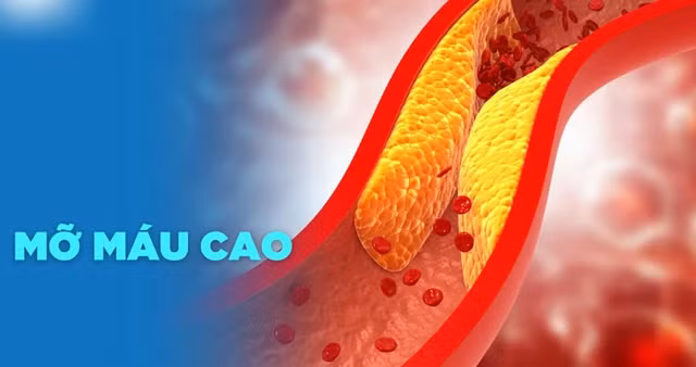 Tăng cholesterol máu không chỉ gây ra xơ vữa mạch, nhồi máu cơ tim, tai biến mạch máu não…có thể dẫn đến tử vong mà còn ảnh hưởng đến đời sống tình dục ở cả nam và nữ.