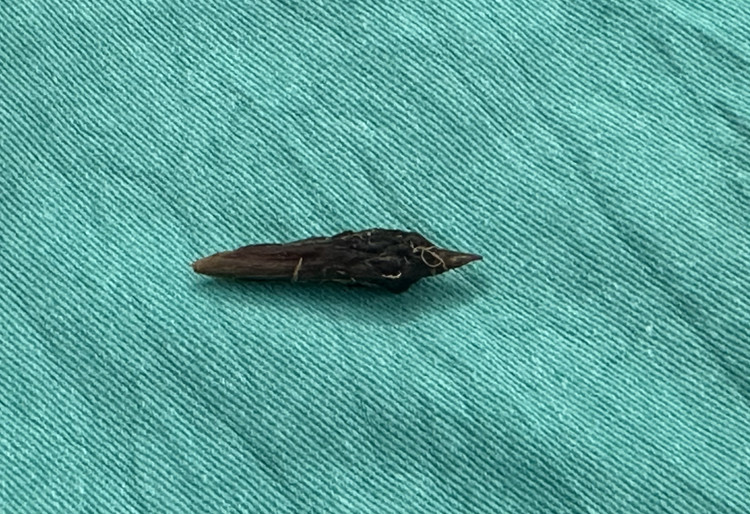 Hạt táo đỏ cứng, sắc nhọn là “thủ phạm” đâm thủng ruột bệnh nhân - Ảnh: BVCC