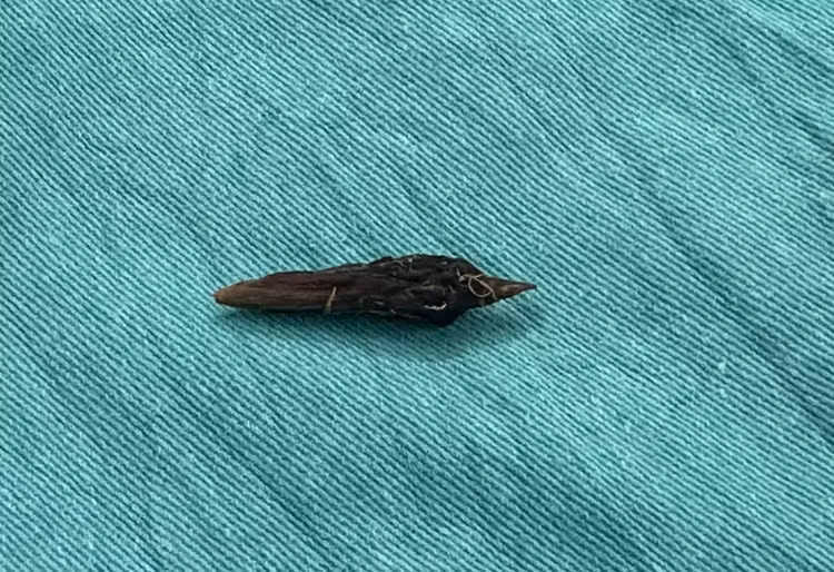 Hạt táo đỏ cứng, sắc nhọn là “thủ phạm” đâm thủng ruột bệnh nhân - Ảnh: BVCC Hạt táo đỏ cứng, sắc nhọn là “thủ phạm” đâm thủng ruột bệnh nhân - Ảnh: BVCC