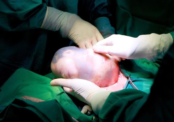 Hai bé song sinh, 1 bé trong bọc điều hiếm gặp - Ảnh BVCC