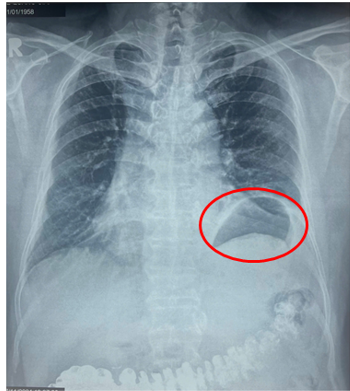 Hình ảnh vòm hoành trái cao bất thường do nhão cơ hoành trái làm giảm thể tích lồng ngực trái gây khó thở gắng sức cho bệnh nhân - Ảnh: BVCC