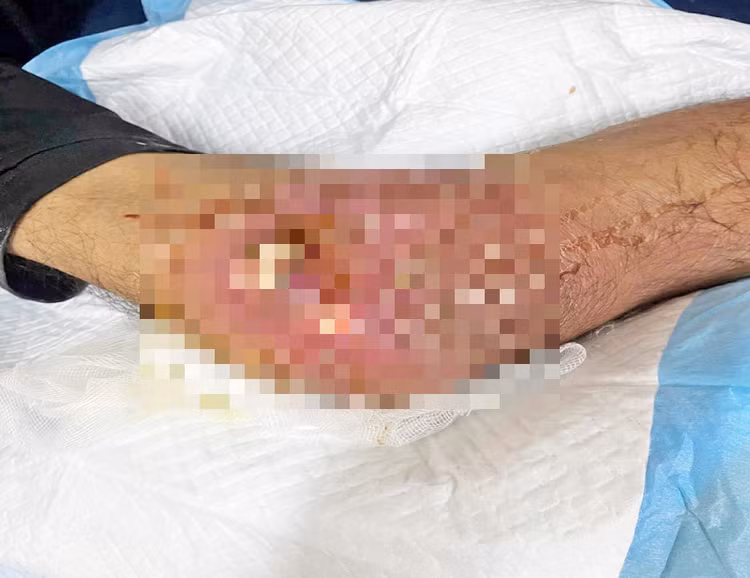 Gối nhiễm trùng nặng do dùng coiticoid - Ảnh BVCC