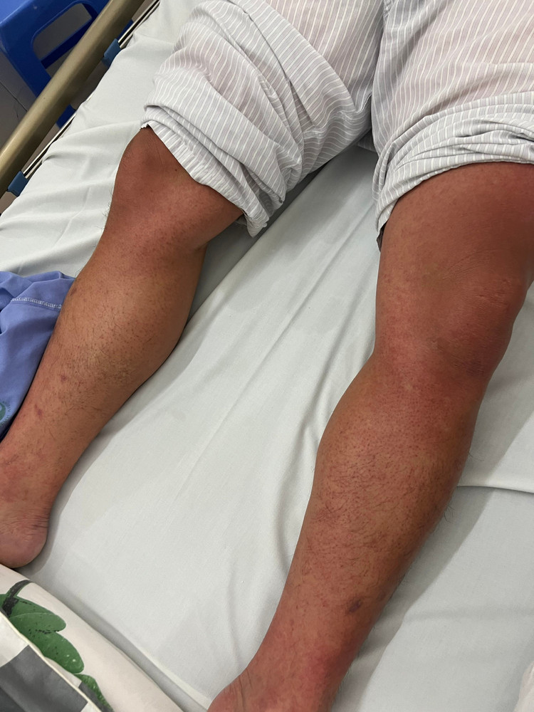 Hình ảnh xuất huyết dưới da của một bệnh nhân bị sốt xuất huyết Dengue - Ảnh: BVCC