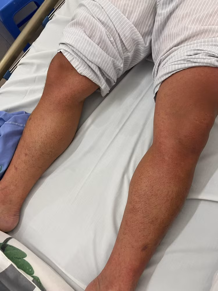 Hình ảnh xuất huyết dưới da của một bệnh nhân bị sốt xuất huyết Dengue - Ảnh: BVCC