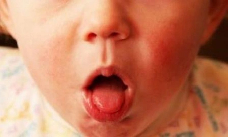 Trường hợp trẻ bị ho gà không được điều trị đúng có thể dẫn tới một số biến chứng nguy hiểm - Ảnh minh hoạ