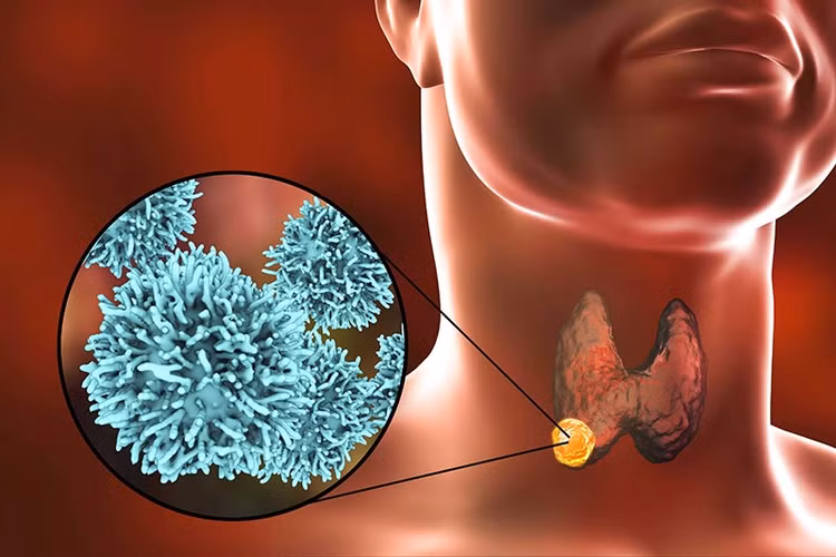 Hiểu về ung thư tuyến giáp để điều trị cho đúng - Ảnh minh hoạ